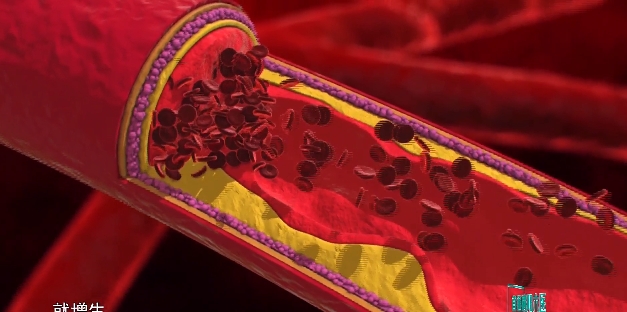 【直通襄陽六醫(yī)】人工血管內(nèi)置支架，打通血透患者“生命線”
