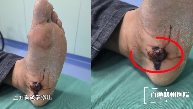 【直通襄州醫(yī)院?】mohs手術(shù)精準(zhǔn)切除黑色素瘤