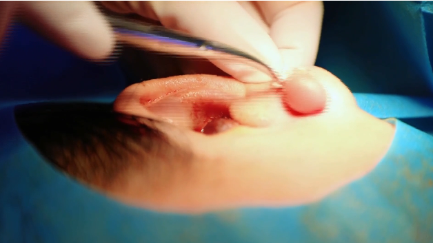 【直通襄陽六醫(yī)】耳洞感染長肉球 手術(shù)放療雙管齊下